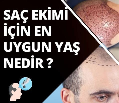 Saç Ekimi İçin Uygun Yaş Aralığı Nedir?